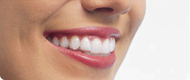 invisalign